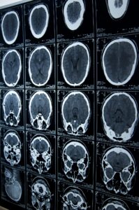 serious injury lawyer in Gretna, LA